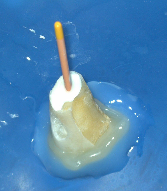 ラバーダム防湿