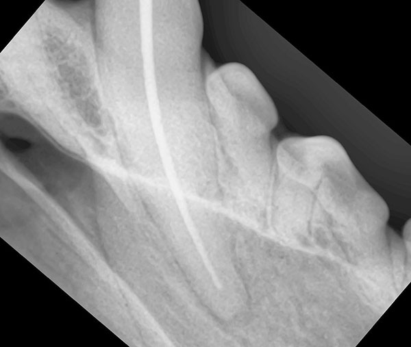 ラバーダム防湿