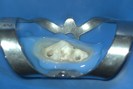 ラバーダム防湿